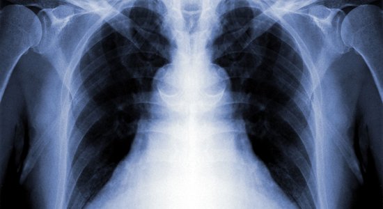 Эксперт: в 2022 году в Латвии туберкулезом заболели более 300 человек, но заболевших может быть больше