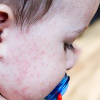 Mazulim pārtikas alerģija: kā atpazīt un no kādiem produktiem tā visbiežāk veidojas