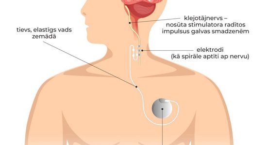 Bērnu slimnīcā paplašinātas iespējas ārstēt epilepsijas pacientus