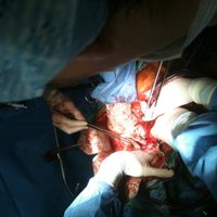 Stradiņa slimnīcā veikta ceturtā aknu transplantācijas operācija Latvijā
