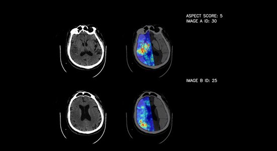 В больнице Страдиня распознавать инсульт поможет искусственный интеллект. Точность - 80%