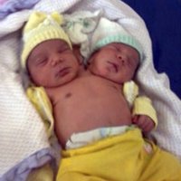 В Бразилии родился двухголовый ребенок