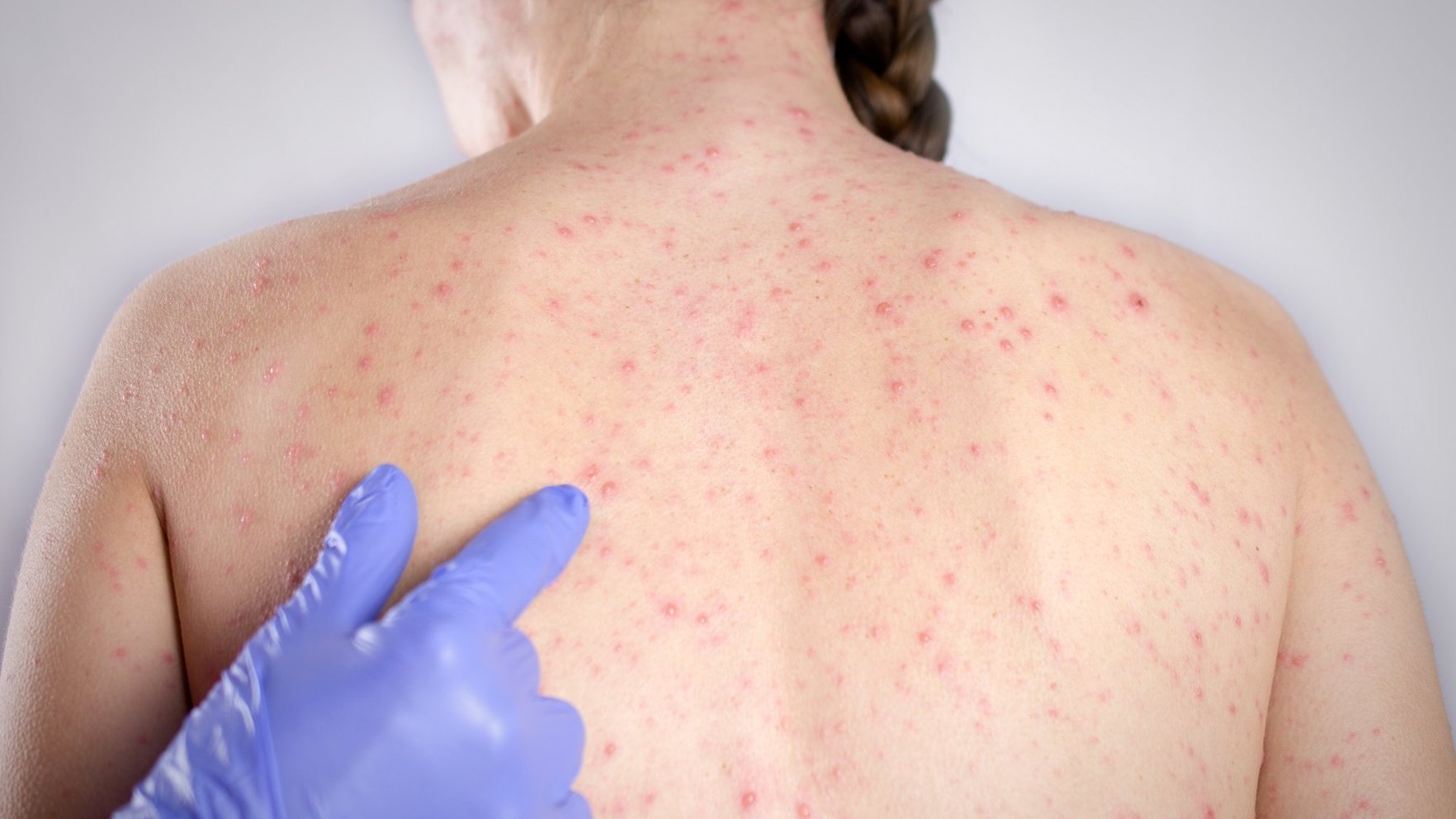 Masalu uzliesmojums Latvijā – reģistrēti jau 29 saslimušie