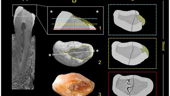 Oldest dental filling neolit . foto - plosone.org