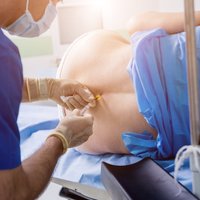 Бесплатная эпидуральная анестезия: наступила ли новая эра в акушерстве?