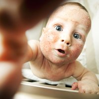 Ādas sausums un nieze: kā atpazīt atopisko dermatītu bērnam