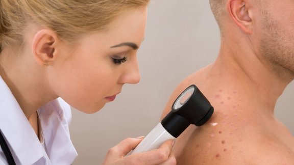 dzimumzīme, melanoma, dermatologs, ārsts