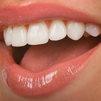 Porcelāna plāksnītes jeb venīri – ceļš pie visbaltākajiem zobiem
