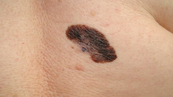 Melanoma - 6