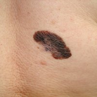 15 gadu laikā Latvijā trīskāršojies no melanomas mirušo skaits