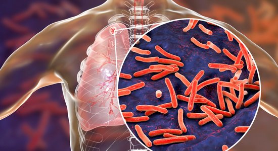 24. marts – Pasaules tuberkulozes diena. Svarīgākais par infekcijas slimību