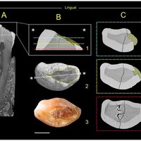 У древнего человека времен неолита был запломбированный зуб