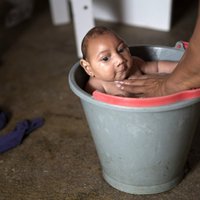 Eiropā piedzimis pirmais mazulis ar Zikas vīrusa izraisīto mikrocefāliju