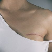 Krūts rekonstrukcija pēc mastektomijas – nepieciešamība, nevis iegriba