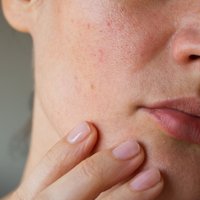 Kļūdas sejas ādas kopšanā, kas izraisa apsārtumu un pūtītes