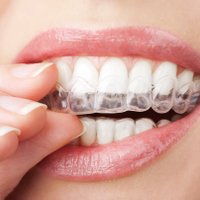 Отбеливание зубов врачи назвали опасным