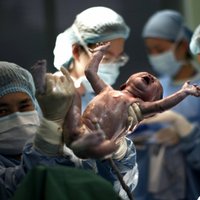 Цену на принятие родов подняли на 50 евро, но ставка для врачей вырастет лишь на 15 центов