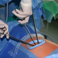 Austrumu slimnīcā pirmo reizi Latvijā caur 'atslēgas caurumu' izņem vēža skartu plaušu
