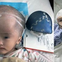 Китайской девочке первой в мире пересадили череп, напечатанный на 3D-принтере