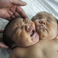 Ķīnā piedzimis bērns ar divām galvām