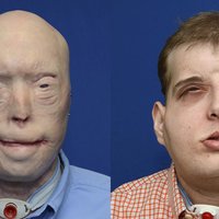 ASV ugunsdzēsējam veikta līdz šim apjomīgākā sejas transplantācija