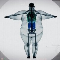 Foto: 440 kg smags onkulis rentgena staros