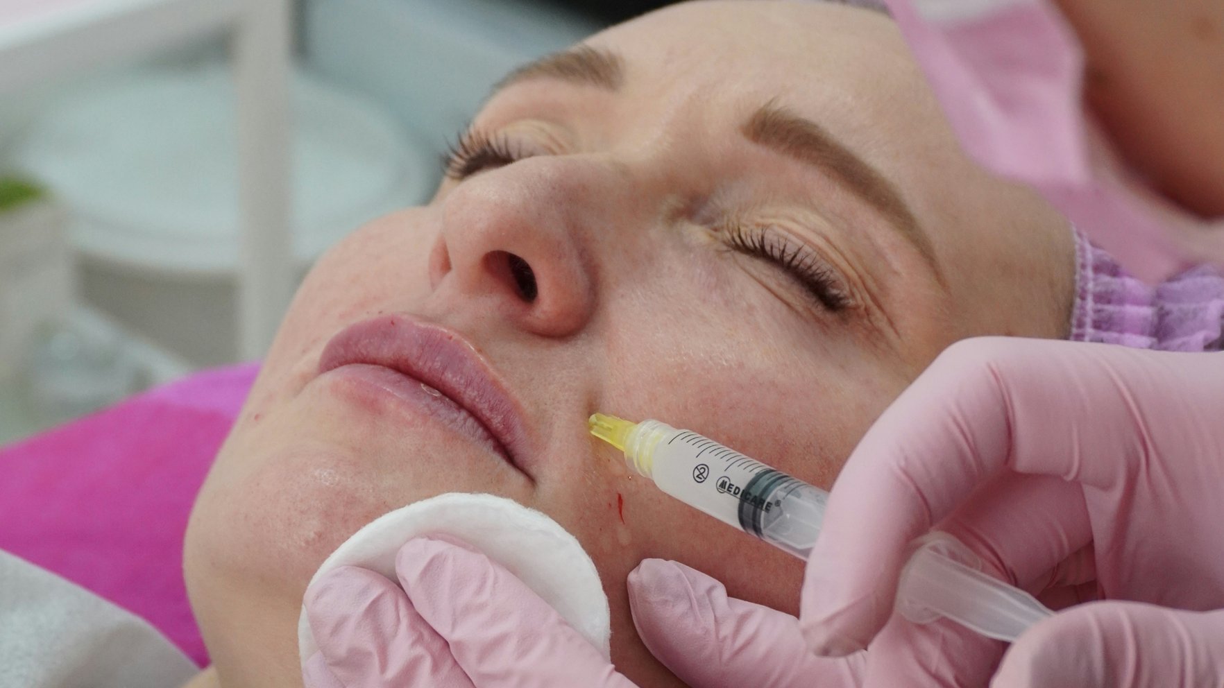 Noslīdējis acs, lūpas kaktiņš un... Botoksa injekcijas blaknes, par kurām reti kad runā skaļi