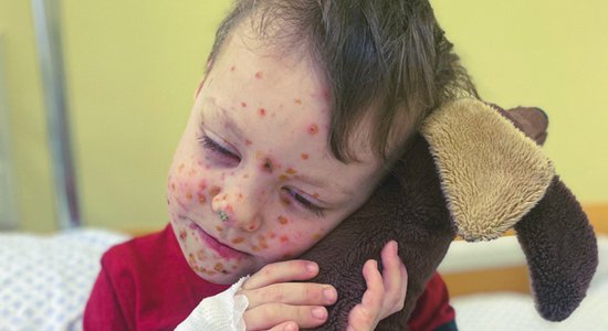 Pēc dēlēna slimošanas mamma Anete mainījusi domas par vakcinēšanos pret vējbakām