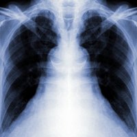 В течение года в Латвии регистрируется более 600 случаев туберкулеза